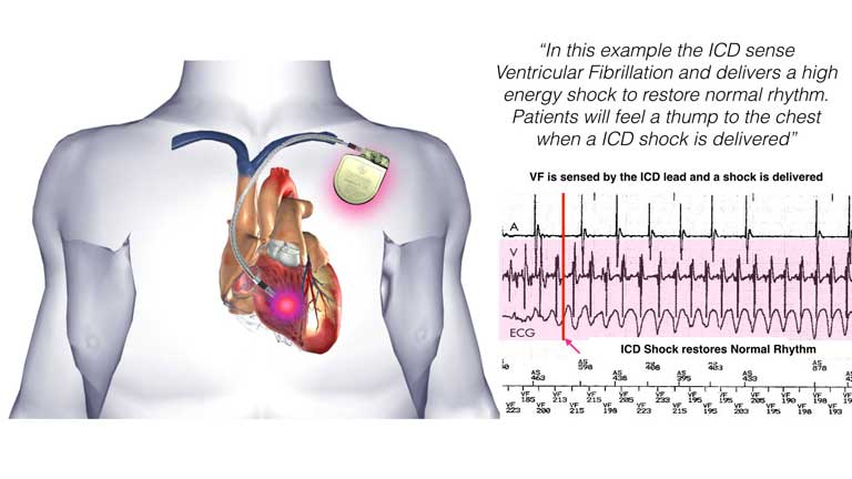 presence of pacemaker icd 10